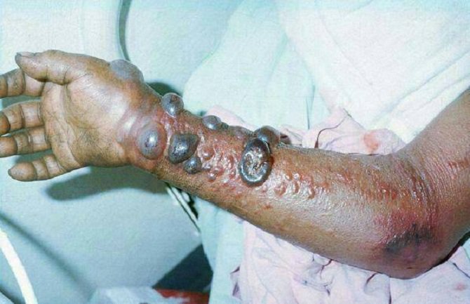 Ebola ubila više od 700 ljudi širom zapadne Afrike