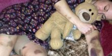 Probudila se prekrivena modricama: Doktori su je hitno hospitalizovali! (VIDEO)