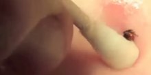 Super jednostavan i bezbjedan trik za vađenje krpelja (VIDEO)