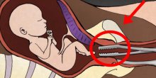 Uznemirujući video: Ginekolog otkriva šta se dešava sa bebom tokom abortusa! 