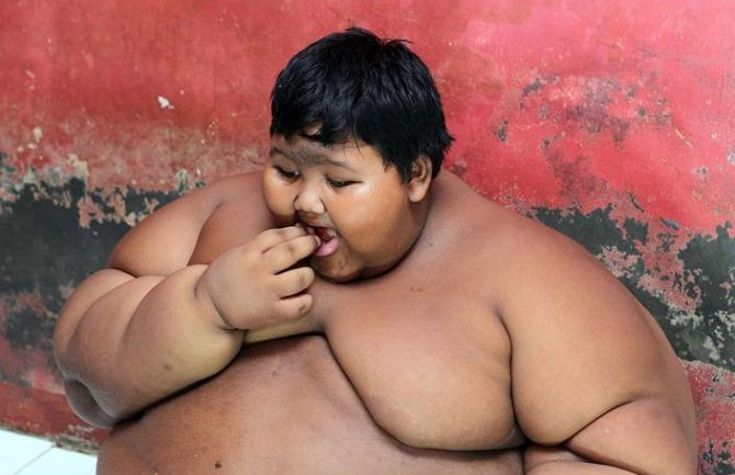 Indonezija: Hospitalizovan desetogodišnji dječak težak 192 kilograma (Foto)