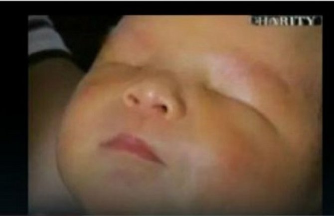 Rijedak poremećaj: Rođen dječak bez očiju (Video)