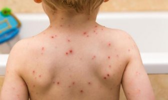 Nastavlja se pad vakcinacije MMR vakcinom, prijeti epidemija boginja