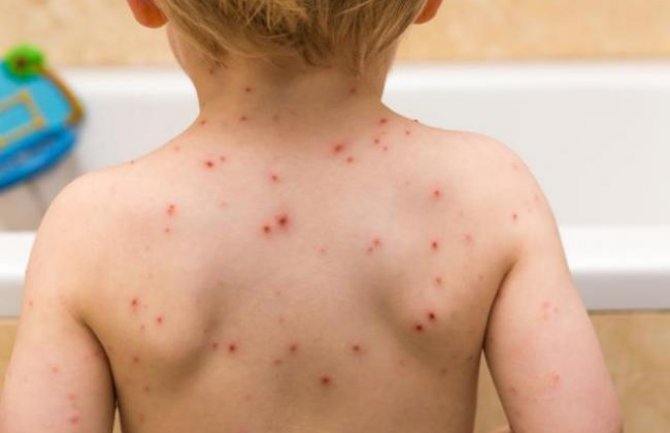 Nastavlja se pad vakcinacije MMR vakcinom, prijeti epidemija boginja