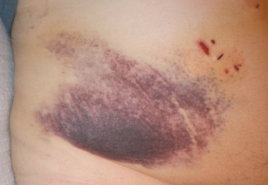 800pxpostgallbladdersurgerybruise830x0