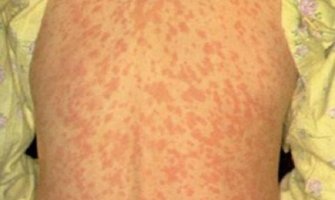 Obuhvat vakcinacije MMR-om ispod 80 odsto, rizik od epidemije