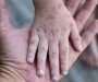 Epidemija morbila i u Podgorici, registrovana tri nova slučaja
